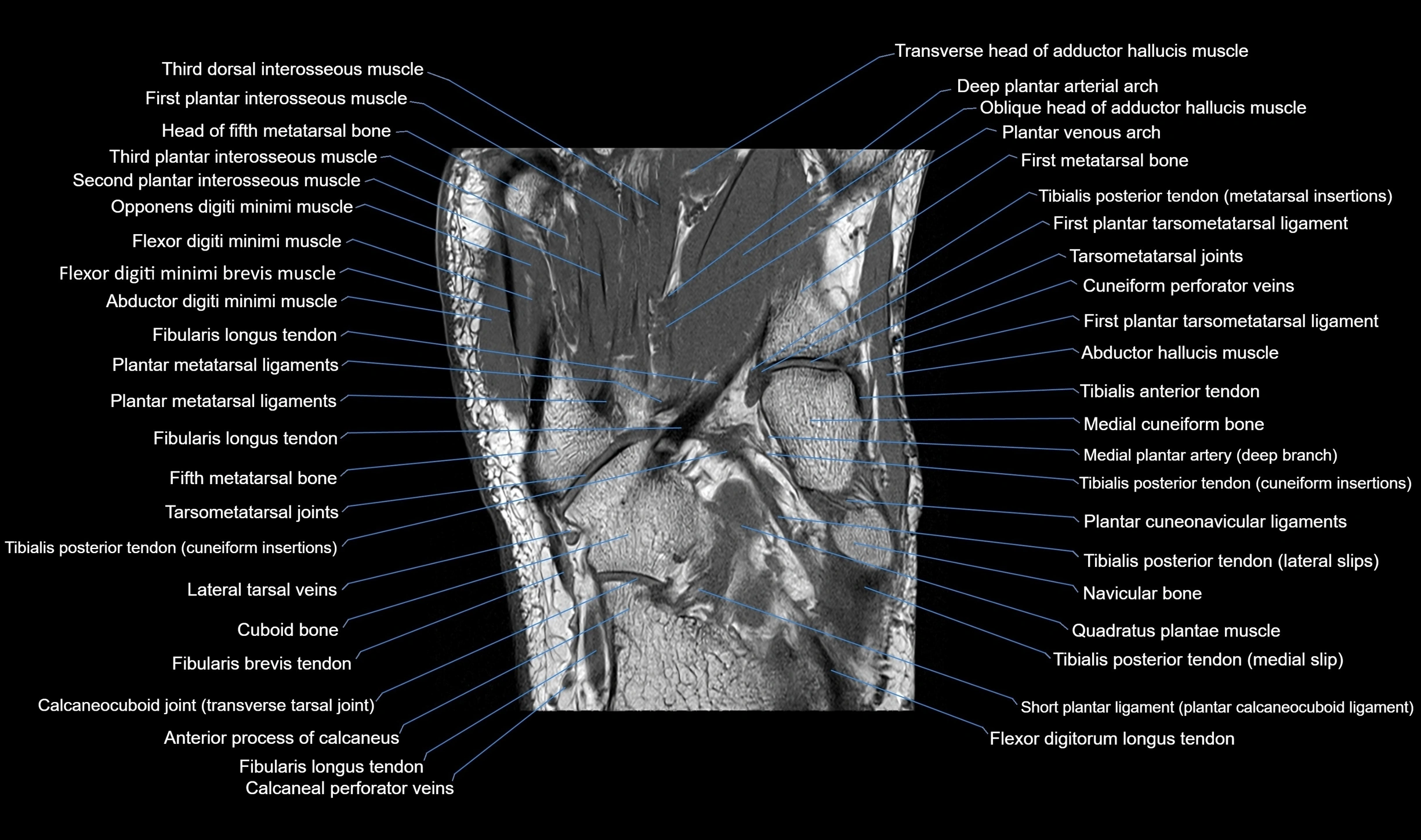 MRI mid foot coronal ligaments cross sectional anatomy 3T  radiology  image-img-00001-00027.webp